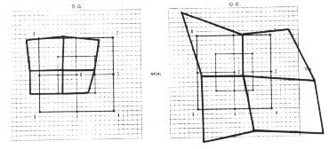 meningiome3.jpg (13500 octets)